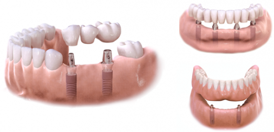 Implanty i protezy na implantach